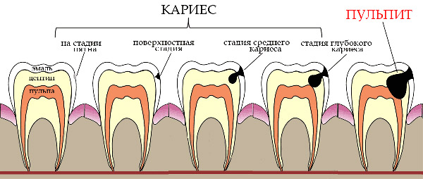 Степень поражения зубов кариесом